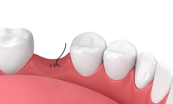 Снятие шва на слизистой оболочке полости рта Снятие шва на слизистой оболочке полости рта