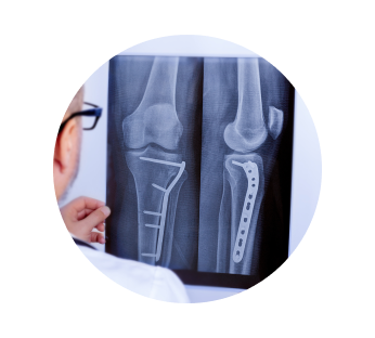 Рентген голени