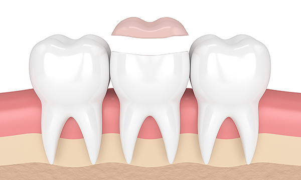 Удаление пломбы Удаление пломбы