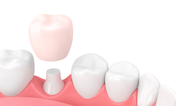 Снятие зубной коронки Снятие зубной коронки