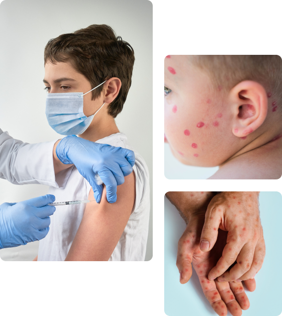 Осложнения после прививки от кори детям Осложнения после прививки от кори детям