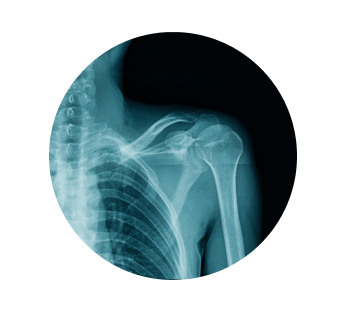 Рентген лопатки