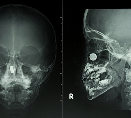 Рентген носоглотки