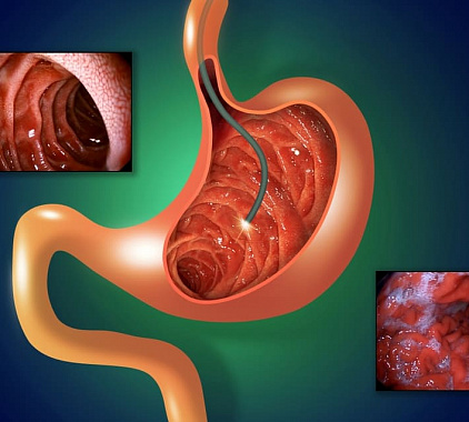 Эндоскопия