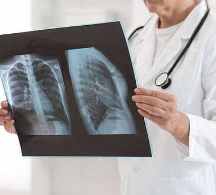 Рентген грудной клетки