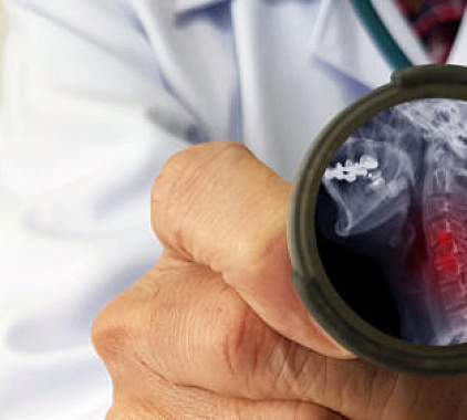 Рентген шейного отдела позвоночника