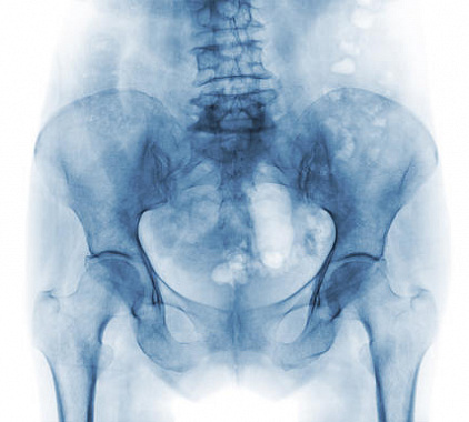 Рентген копчика