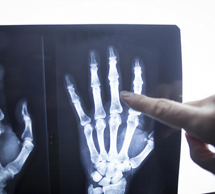 Рентген пальцев Рентген пальцев