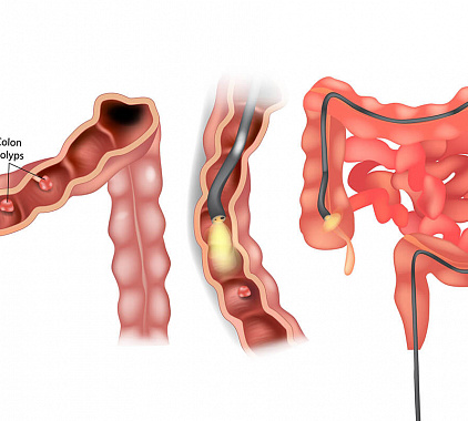Ректороманоскопия Ректороманоскопия