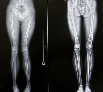 Рентген костей Рентген костей