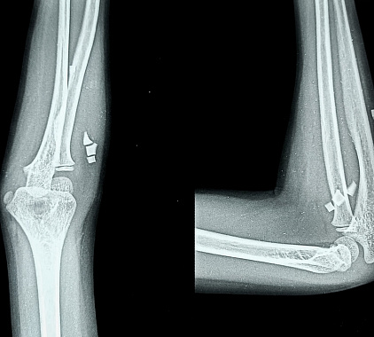 Рентген локтевого сустава Рентген локтевого сустава
