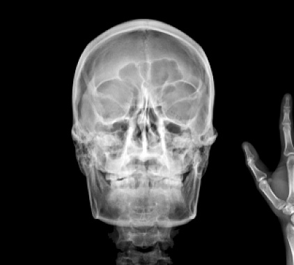 Рентген носоглотки